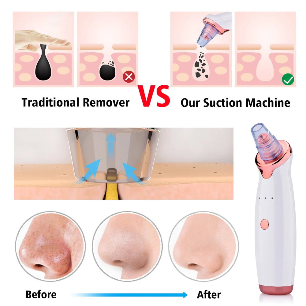 Electric Vacuum Blackhead Removal